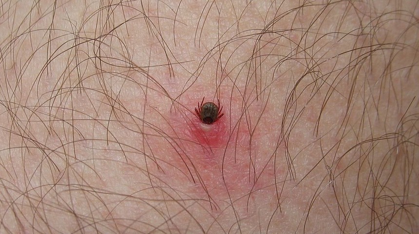 1024px-Tick lodged in human host